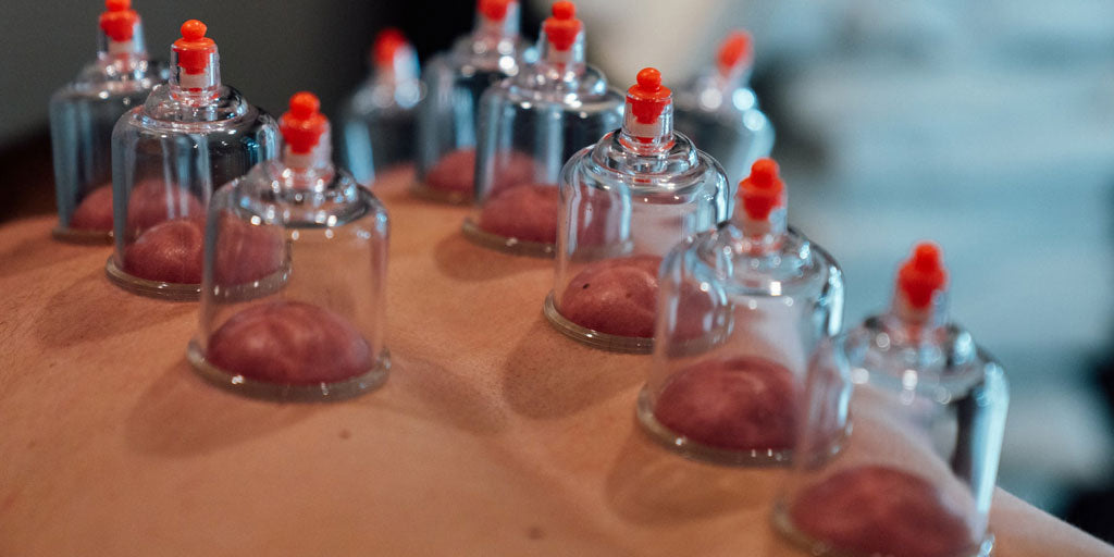 cupping therapy