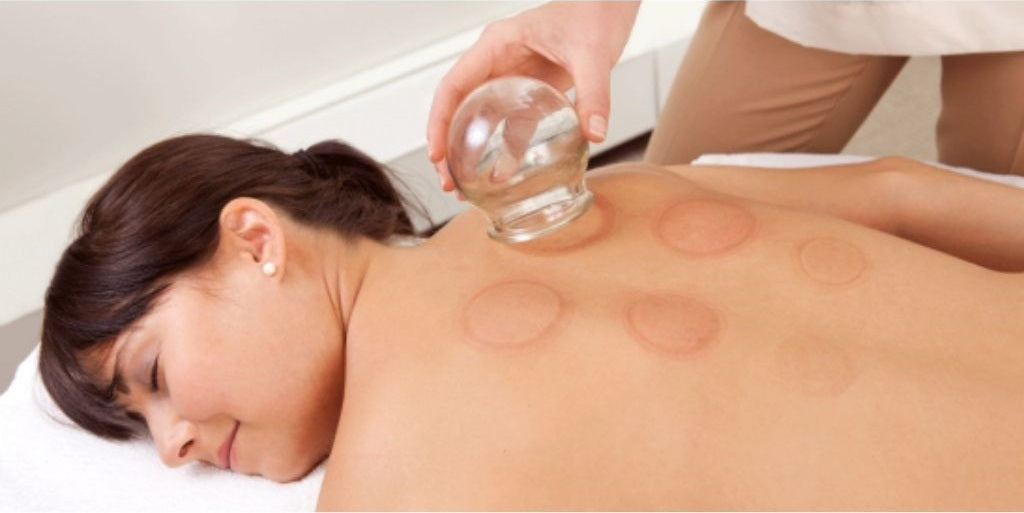 cupping marks