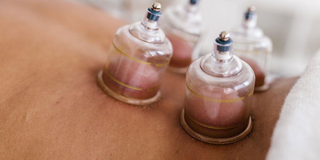 stationary cupping